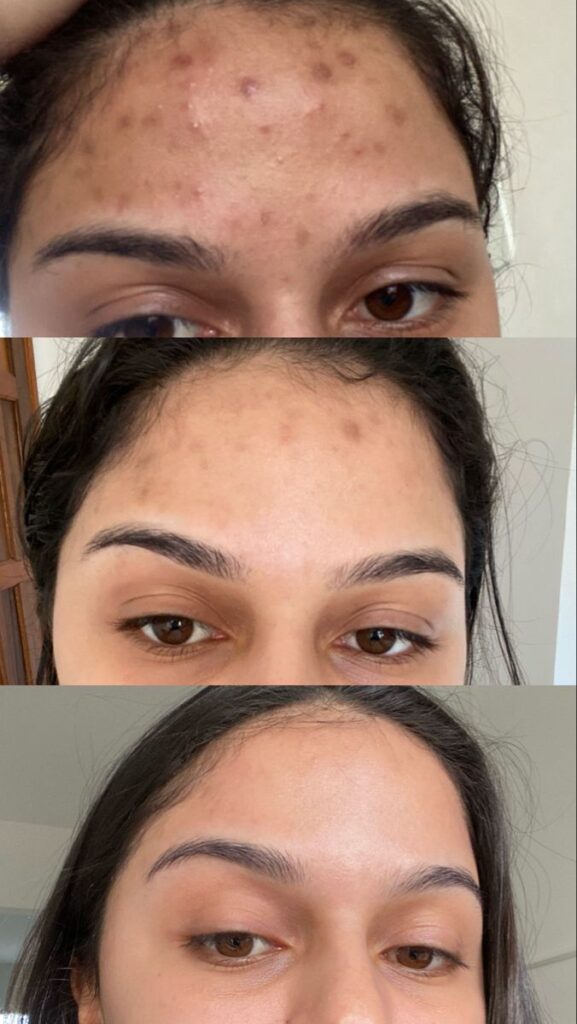 A before and after skincare progress photo